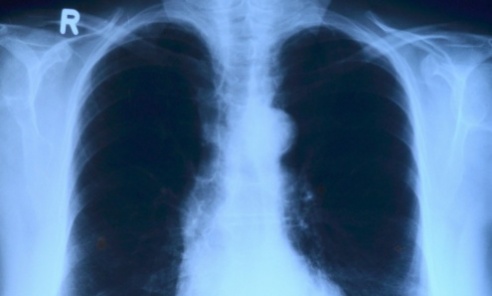 Naukowcy: COVID-19 wyzwala w płucach nieoczekiwany mechanizm - Serwis informacyjny z Wodzisławia Śląskiego - naszwodzislaw.com